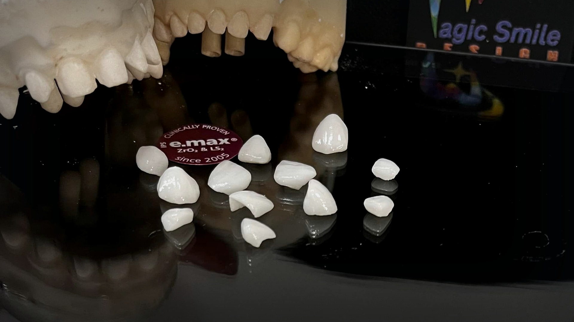 Ceramic veneers on a dental model with visible cervical contour, fine volume and realistic laboratory context